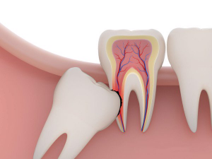 Nhổ răng 8 có nguy hiểm không – Quy trình nhổ răng số 8 chuẩn